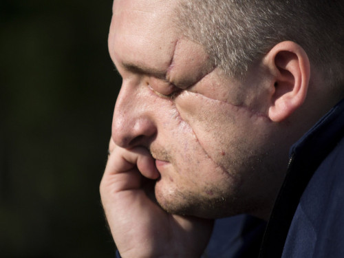 «Прокинувся і думав, що я у полоні» – ветеран, який втратив очі, став психологом та створив блог